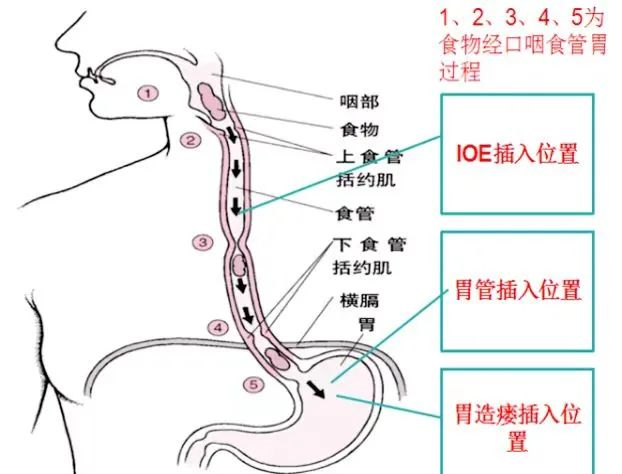 告别吞咽困难！康复医学科成功开展间歇经口置管（IOE）新技术 - 南方科技大学医院