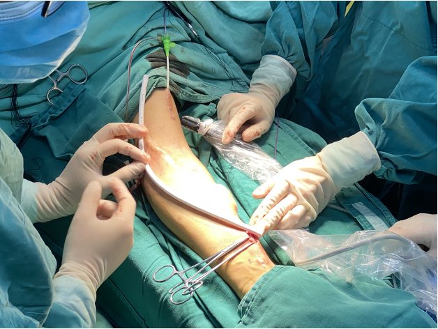 南科大医院开展人工血管转流术，为血透患者打通“生命线”