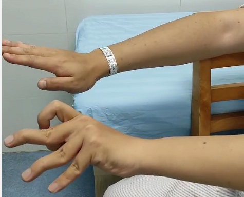 患者术前手部状态